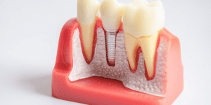 Dental implant in Belleville